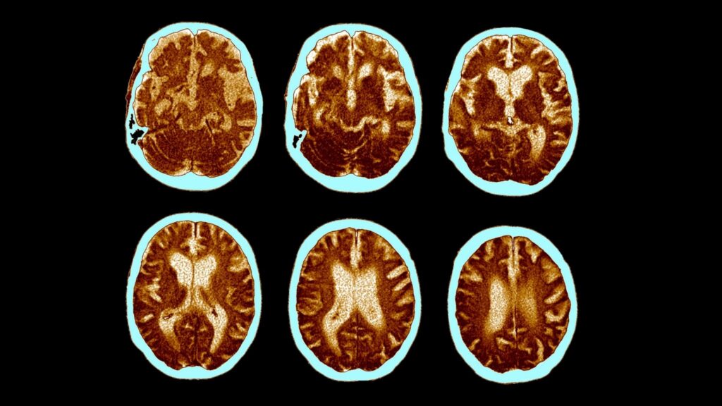 Imagens de tomografia computadorizada (TC) colorida exibindo um corte axial da cabeça de um paciente de 74 anos diagnosticado com Alzheimer.