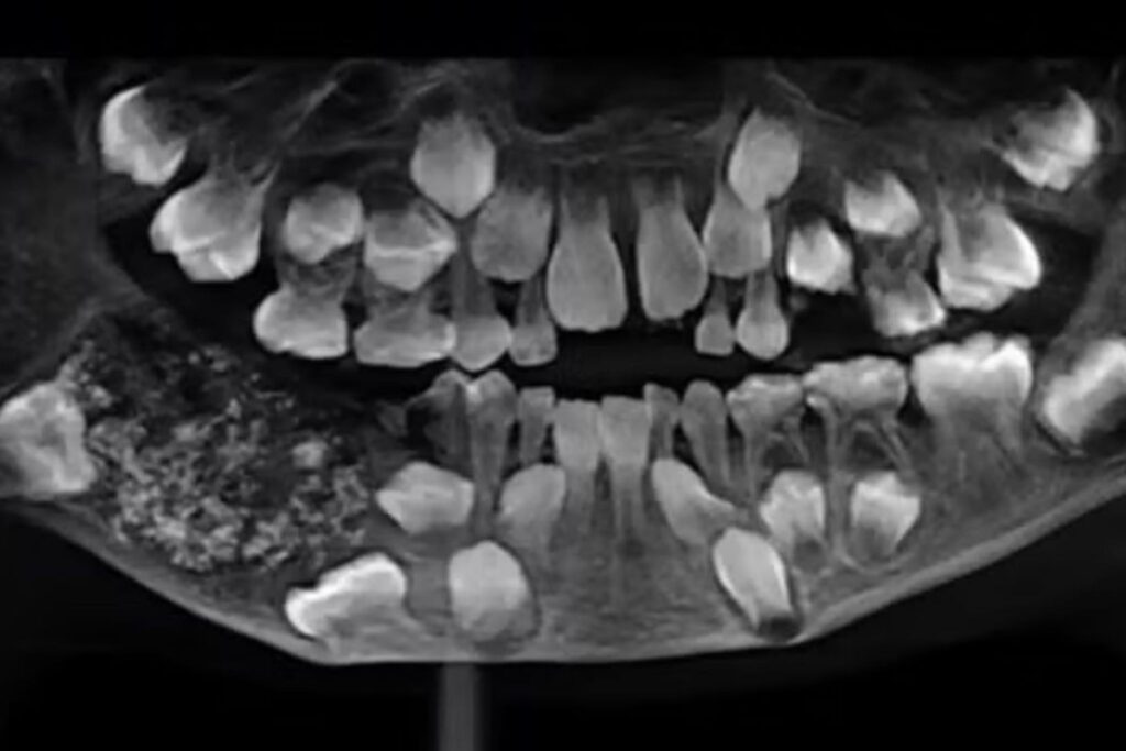 extração de 526 dentes de menino indiano