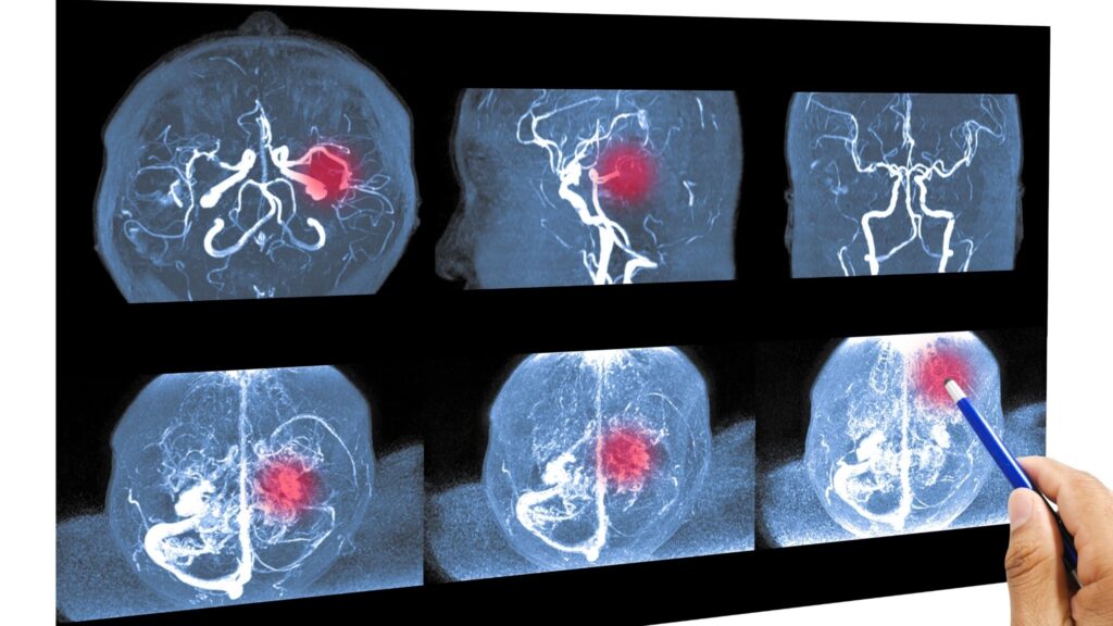 sintoma de aneurisma cerebral