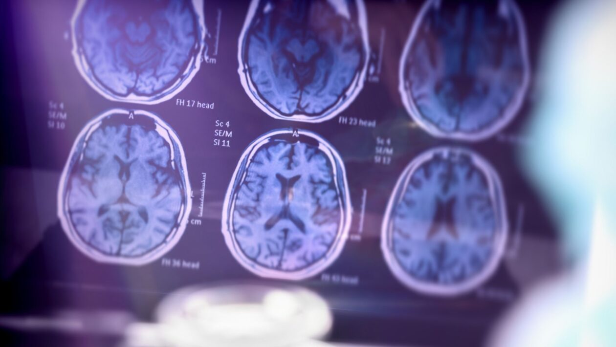 Estudo científico sobre a doença de Alzheimer realizado em ambiente hospitalar, com imagem ilustrativa.