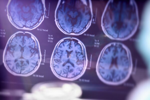 Estudo científico sobre a doença de Alzheimer realizado em ambiente hospitalar, com imagem ilustrativa.