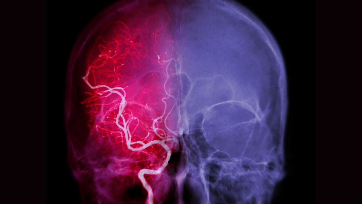 sintoma de aneurisma cerebral