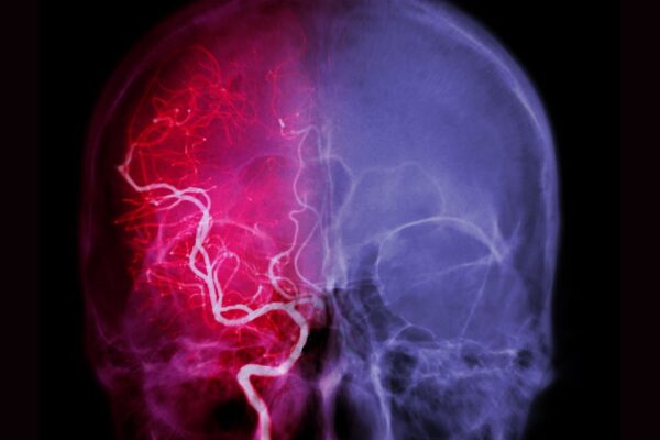 sintoma de aneurisma cerebral