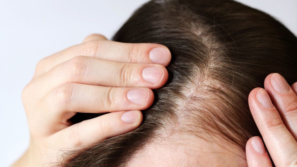 Medicamento promete fios mais fortes e couro cabeludo saudável. (Foto: Mariia Klymenko via Canva)