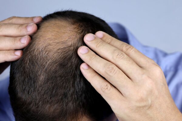 Nova pílula estimula o crescimento capilar em poucos meses. (Foto: Getty Images via Canva)