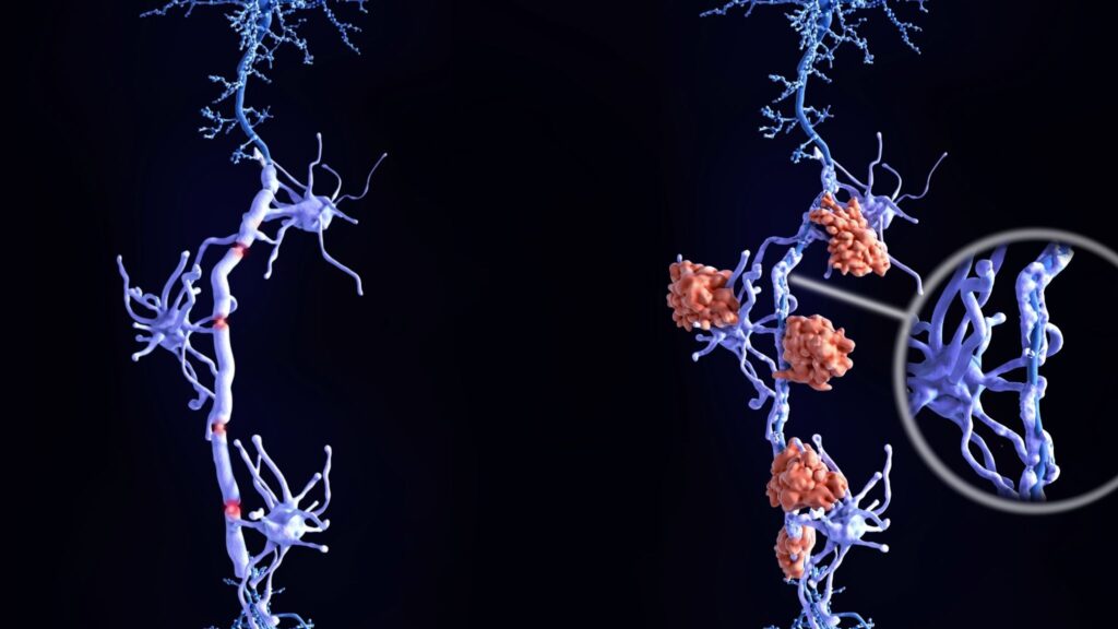 Novo estudo mostra início precoce da EM no cérebro. (Foto: Getty Images via Canva)