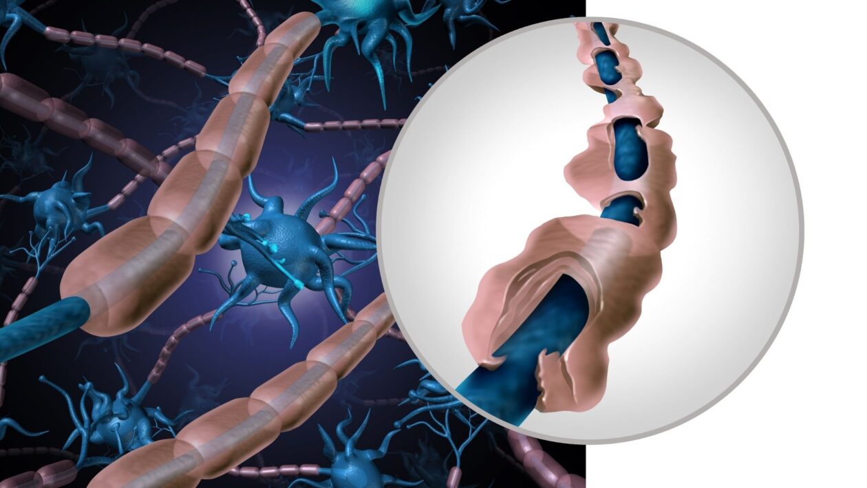 Proteínas no sangue podem revelar a EM cedo. (Foto: Getty Images via Canva)