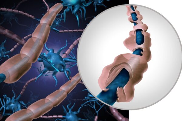 Proteínas no sangue podem revelar a EM cedo. (Foto: Getty Images via Canva)