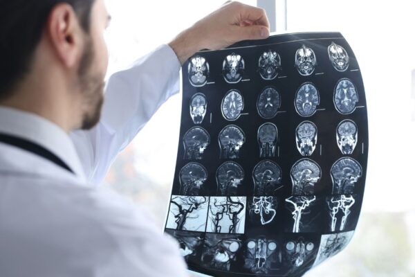 Proteína ligada ao início do Parkinson é identificada. (Foto: Africa Images via Canva)