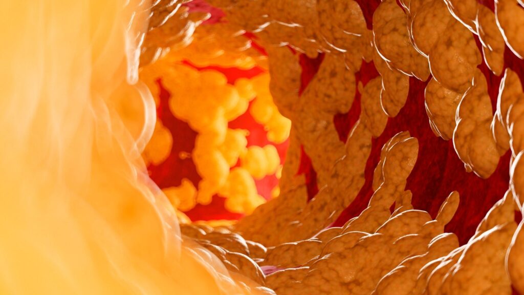 Gordura escondida aumenta chance de derrame e infarto. (Foto: Science Photo Library via Canva)