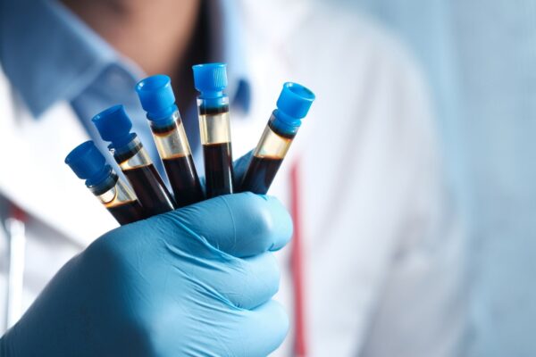 Exame de sangue detecta Alzheimer com alta precisão. (Foto: Pexels via Canva)