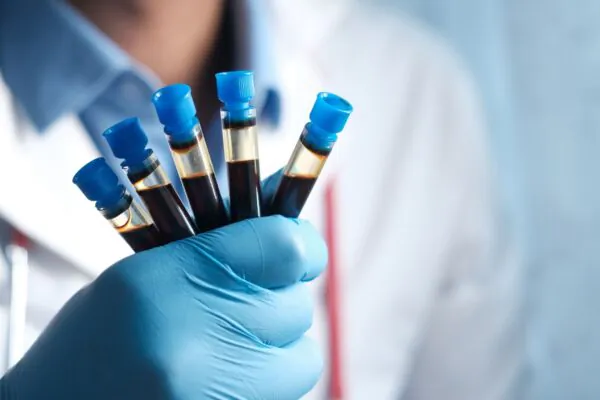 Exame de sangue detecta Alzheimer com alta precisão. (Foto: Pexels via Canva)