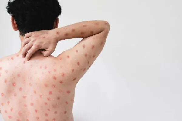Variante mais grave da mpox surge nos EUA. (Foto: Getty Images via Canva)