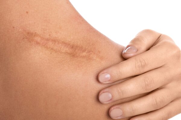 Proteína SerpinB3 acelera o fechamento de feridas na pele. (Foto: Getty Images via Canva)