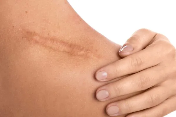 Proteína SerpinB3 acelera o fechamento de feridas na pele. (Foto: Getty Images via Canva)