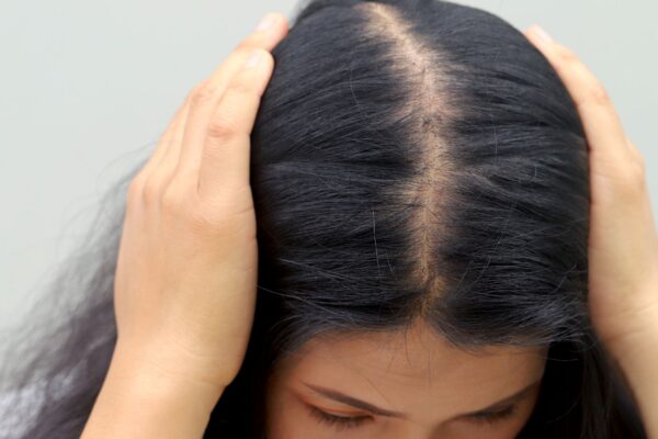 Queda de cabelo pode indicar deficiência de ferro ou vitamina D. (Foto: Rattanakun via Canva)
