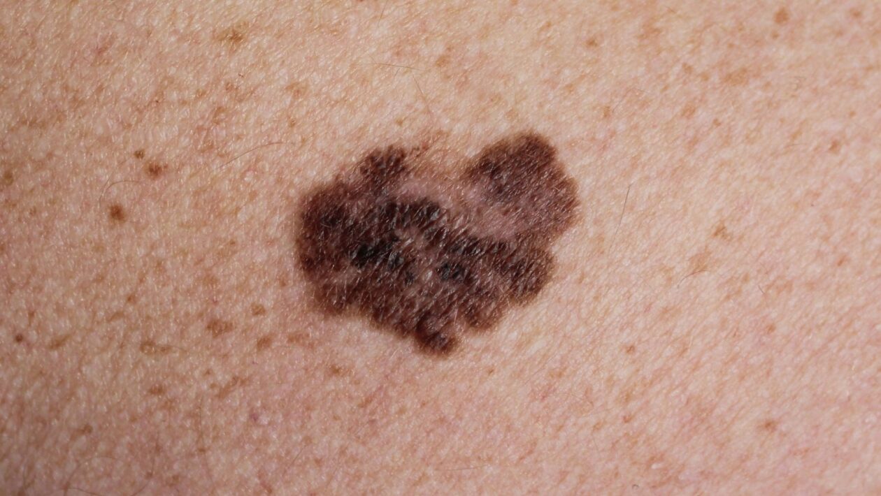 IA identifica melanoma agressivo com alta precisão. (Foto: Getty Images via Canva)
