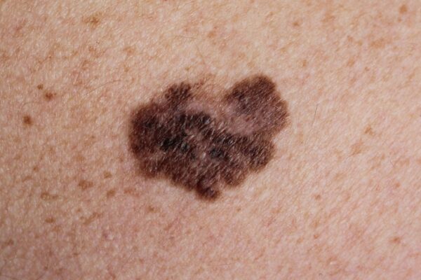 IA identifica melanoma agressivo com alta precisão. (Foto: Getty Images via Canva)