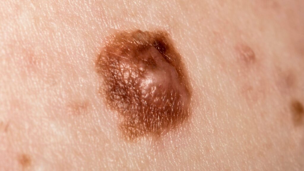 Inovação acelera detecção do melanoma em fases iniciais. (Foto: Getty Images via Canva)