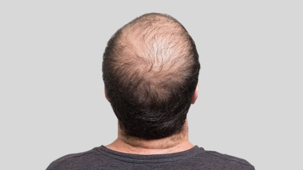 Tratamento inovador melhora resultados contra a calvície. (Foto: Getty Images via Canva)