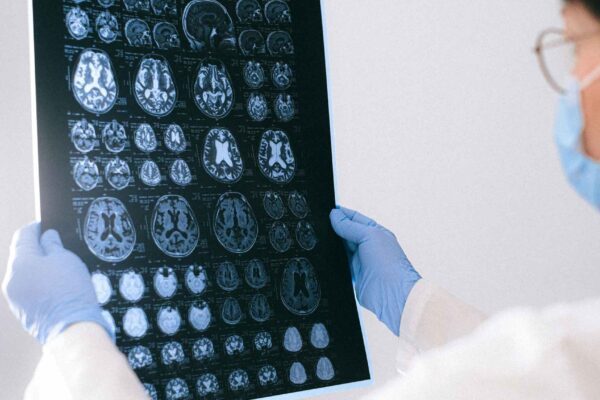 Estudo brasileiro revela que inflamação cerebral pode acelerar o Alzheimer (Imagem: Pexels/ Canva Pro)