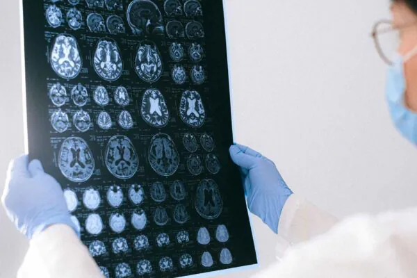 Estudo brasileiro revela que inflamação cerebral pode acelerar o Alzheimer (Imagem: Pexels/ Canva Pro)