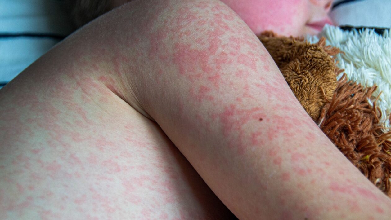 Baixa cobertura vacinal reabre caminho para novos surtos. (Foto: Getty Images via Canva)