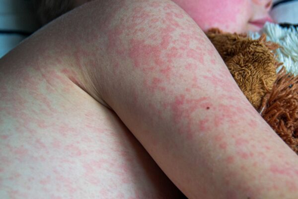 Baixa cobertura vacinal reabre caminho para novos surtos. (Foto: Getty Images via Canva)