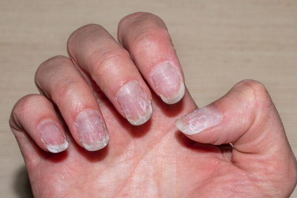 Unhas podem indicar problemas de saúde internos. (Foto: Getty Images via Canva)