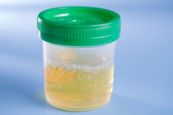 Xixi alterado pode sinalizar infecção urinária. (Foto: Getty Images via Canva)