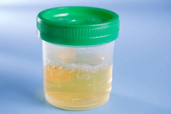 Xixi alterado pode sinalizar infecção urinária. (Foto: Getty Images via Canva)