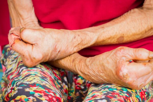 Mato Grosso lidera casos de hanseníase em 2024. (Foto: Getty Images via Canva)