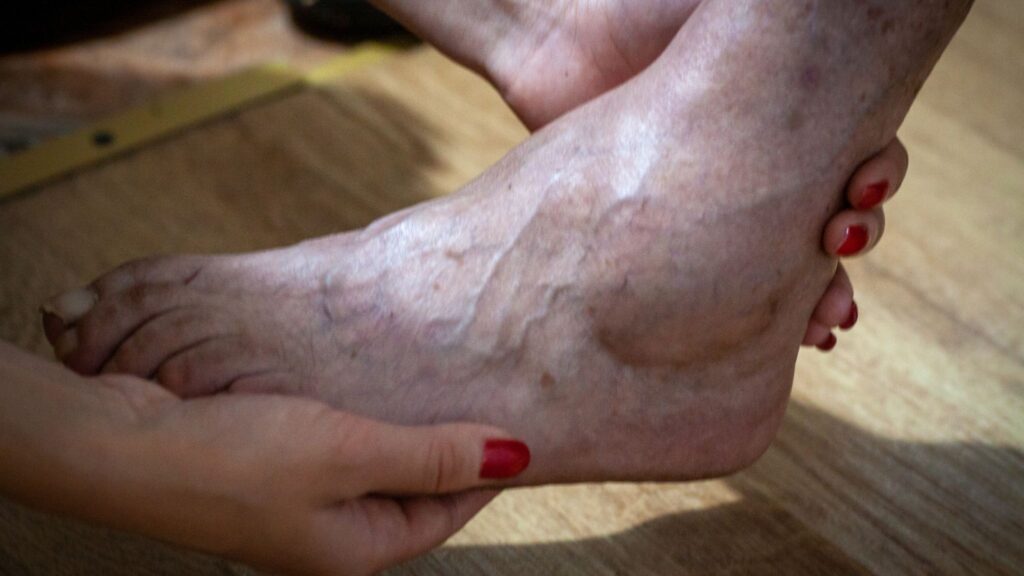 Sintomas incluem manchas e perda de sensibilidade. (Foto: Getty Images via Canva)