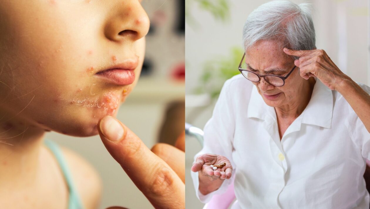 Vírus da catapora pode aumentar risco de demência. (Foto: Getty Images / Boontanataweepol's Images via Canva)