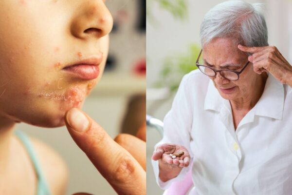 Vírus da catapora pode aumentar risco de demência. (Foto: Getty Images / Boontanataweepol's Images via Canva)