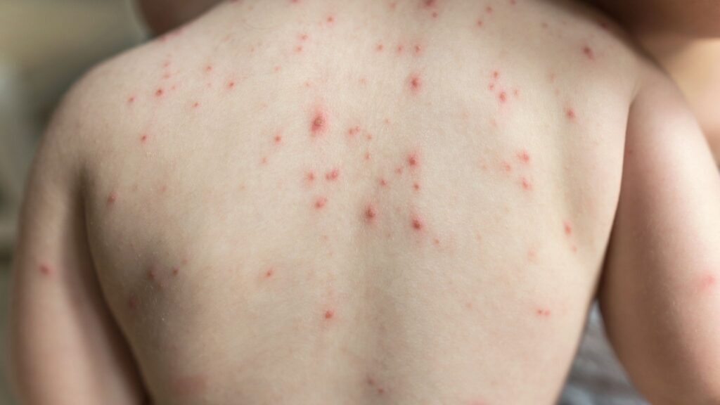 Prevenir herpes-zóster ajuda a proteger o cérebro. (Foto: Getty Images via Canva)