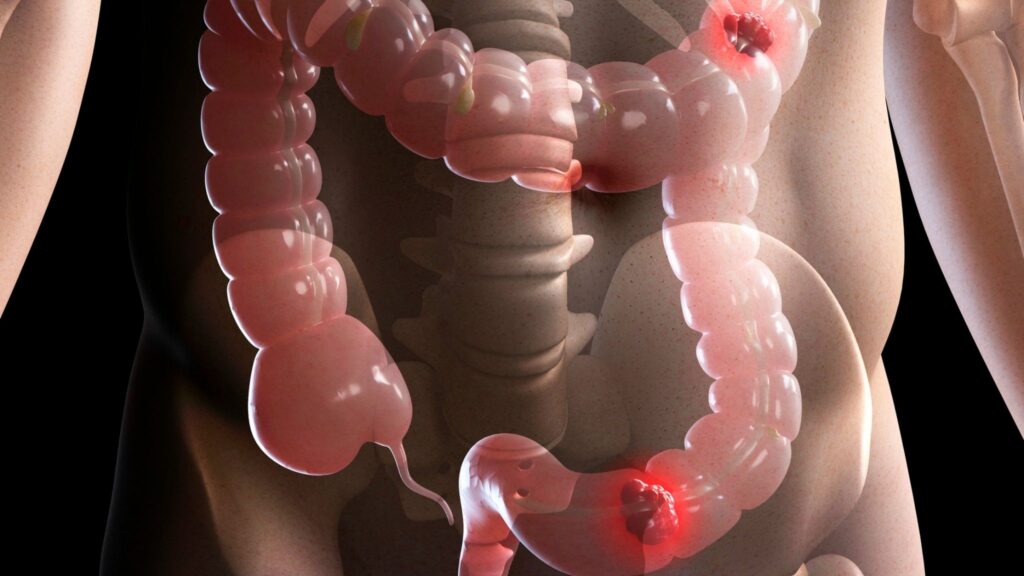 Detecção precoce pode salvar vidas contra o câncer de cólon. (Foto: Photo Library via Canva)