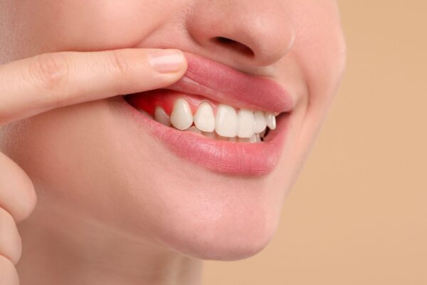 Bebidas ácidas aumentam o risco de erosão dentária. (Foto: Africa Images via Canva)