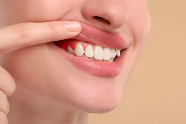 Bebidas ácidas aumentam o risco de erosão dentária. (Foto: Africa Images via Canva)