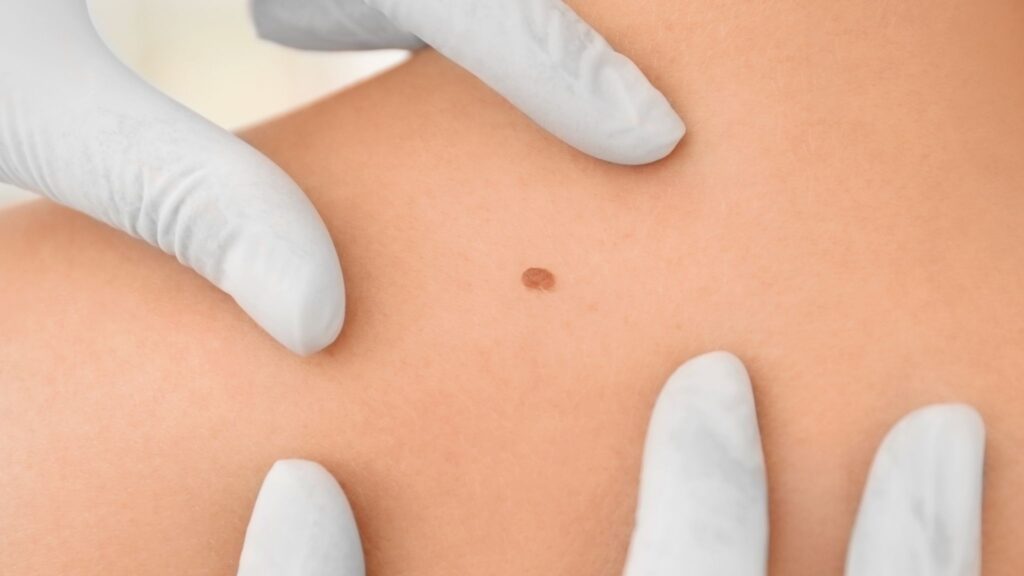 Mudança em pintas ou sinais exige avaliação médica rápida. (Foto: Pixelshot via Canva)