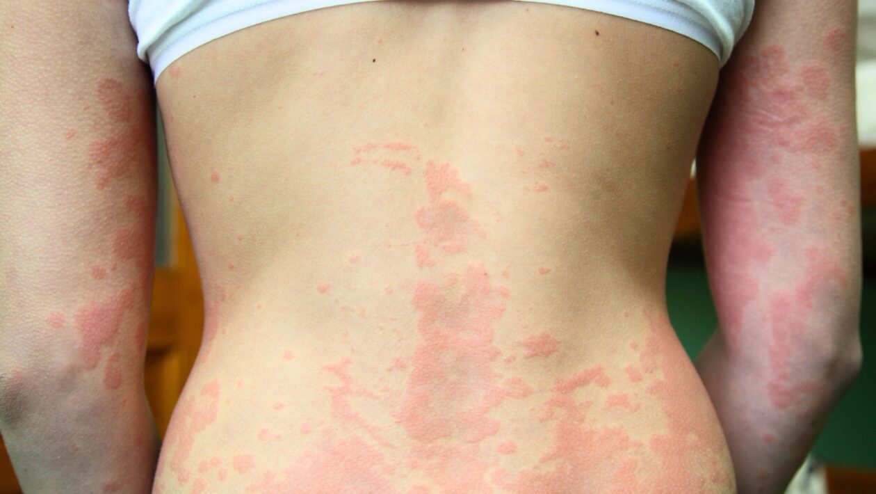 Dermatite atópica pode aumentar o risco de fraturas. (Foto: Photo Library via Canva)