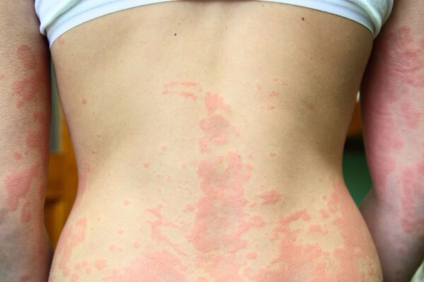 Dermatite atópica pode aumentar o risco de fraturas. (Foto: Photo Library via Canva)