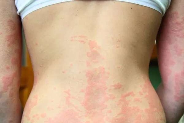 Dermatite atópica pode aumentar o risco de fraturas. (Foto: Photo Library via Canva)