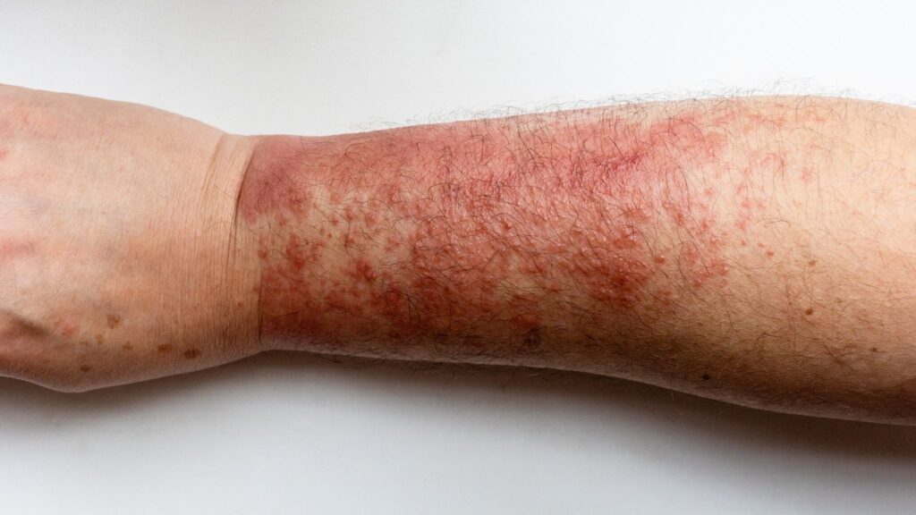 Inflamação da dermatite pode reduzir densidade óssea. (Foto: Vvoevale via Canva)