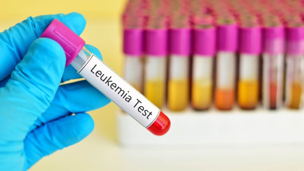 CytoDiffusion identifica leucemia antes de especialistas humanos (Imagem: Getty Images/ Canva Pro)