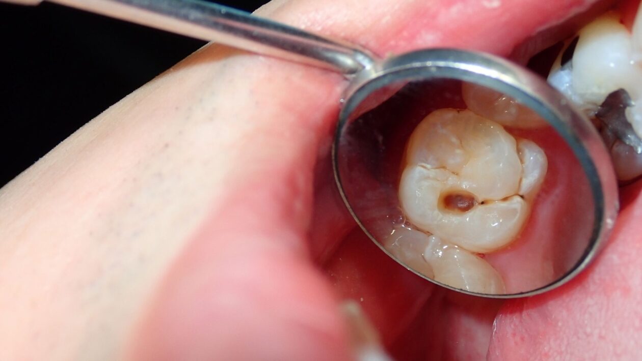 Arginina aumenta o pH e reduz acidez no biofilme dental. (Foto: Getty Images via Canva)