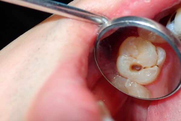 Arginina aumenta o pH e reduz acidez no biofilme dental. (Foto: Getty Images via Canva)
