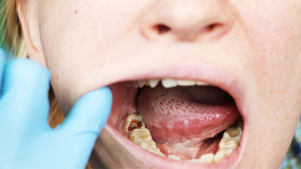 Estudo clínico confirma arginina como estratégia para prevenção de cáries. (Foto: Alena via Canva)