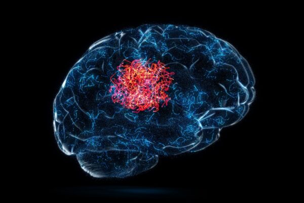 Tumor cerebral pode começar em células aparentemente normais. (Foto: Getty Images via Canva)