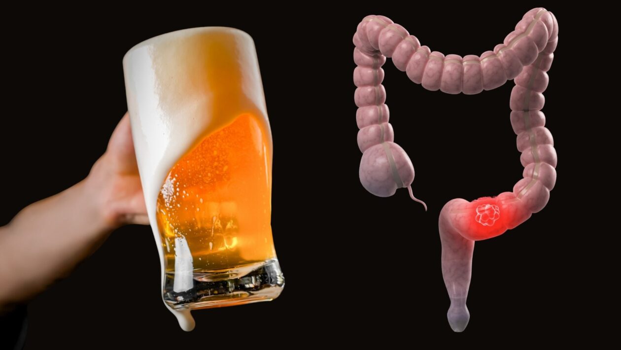 Consumo prolongado de álcool eleva risco de câncer retal. (Foto: Getty Images e Photo Library via Canva)